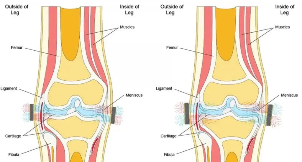 Learn the best placement for knee pain relief patches. Discover where to apply patches for better comfort, circulation support, and overnight relief.